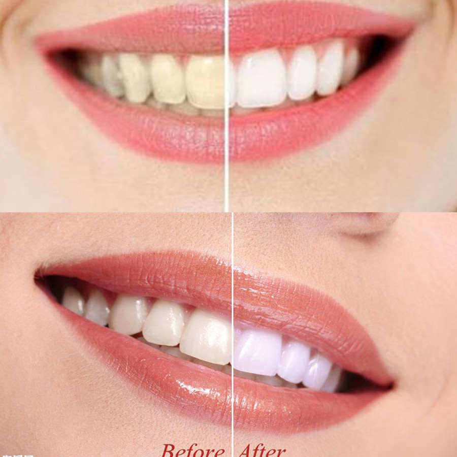 Dentes de carvão vegetal de ba - Teeth Whitening Co avaliação e preço