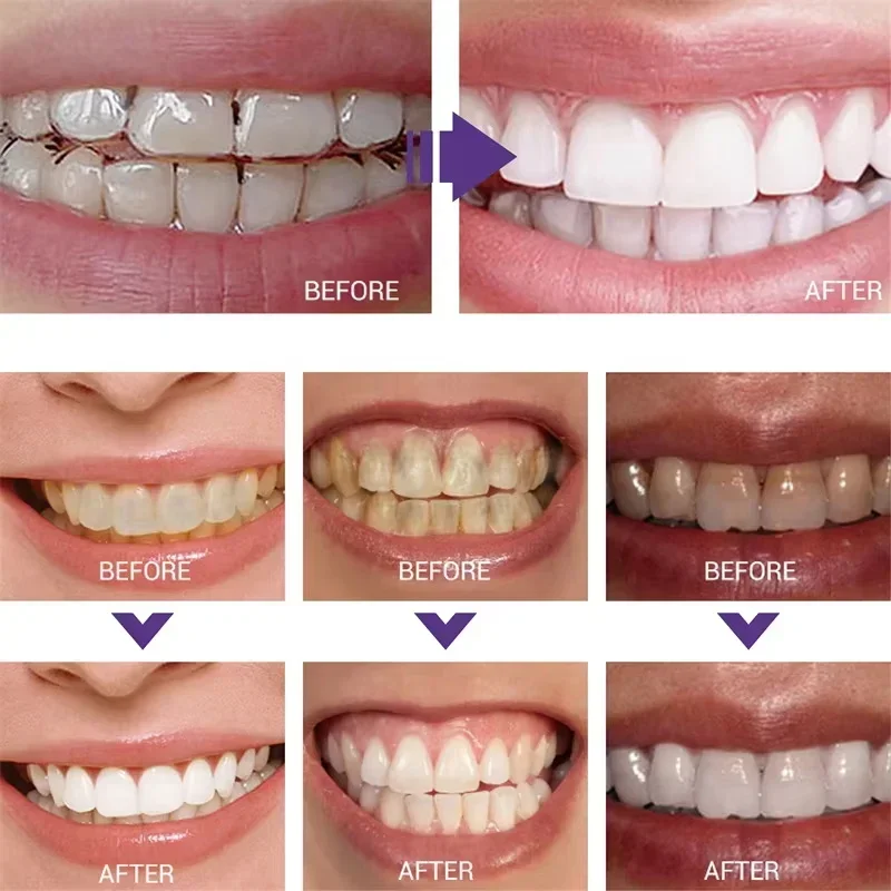 Limpeza dos dentes branqueamen - Teeth Whitening In Korea avaliação e preço