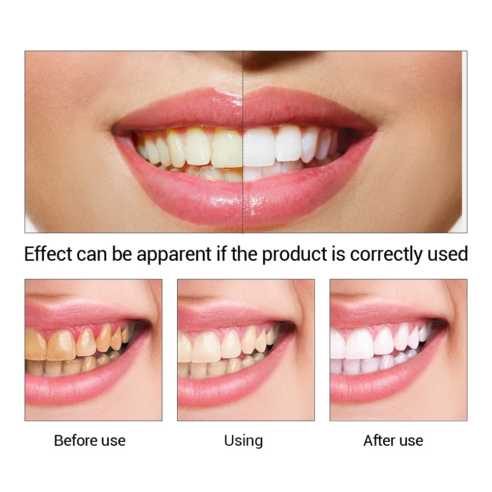 FTEENPLY Essência para claream - Teeth Whitening Co avaliação e preço